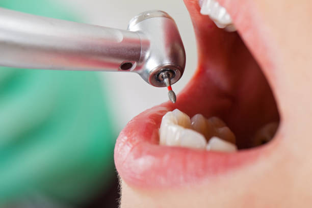 Best Broken or Cracked Tooth Emergency Dentist in Montara, CA